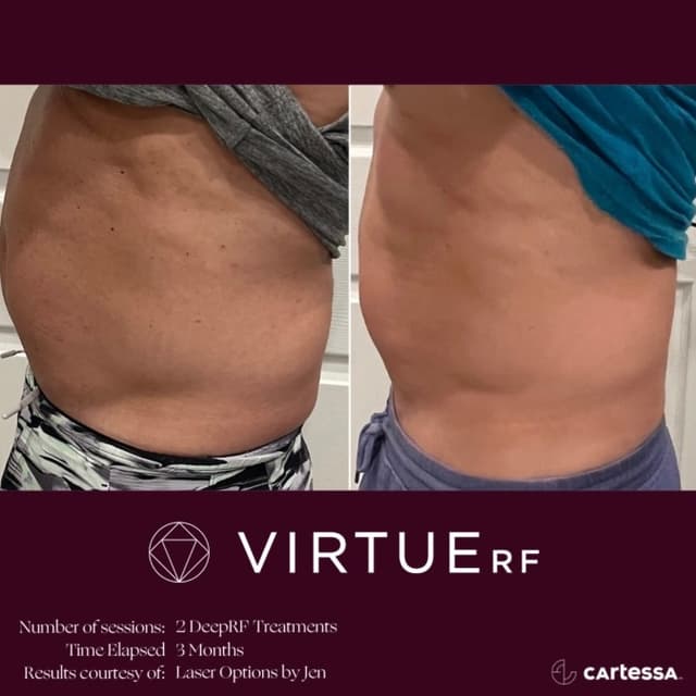 DeepRF Microneedling at Laser Options by Jen in Scottsdale, AZ