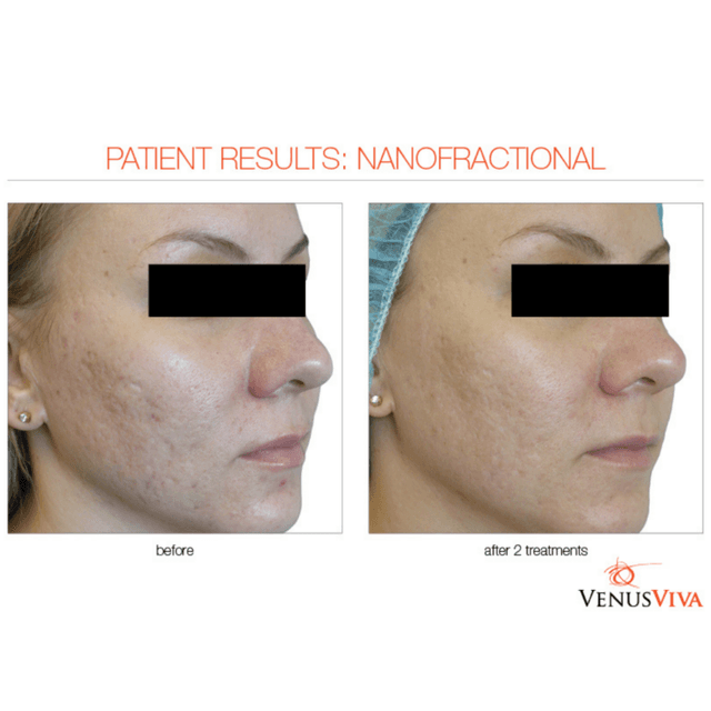3 RF NanoFractional at Laser Options by Jen in Scottsdale, AZ