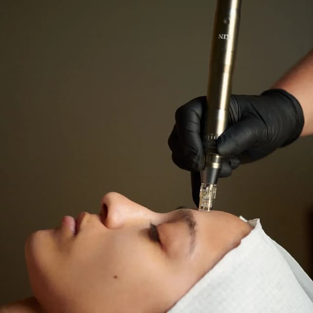 3 Microneedling at Laser Options by Jen in Scottsdale, AZ